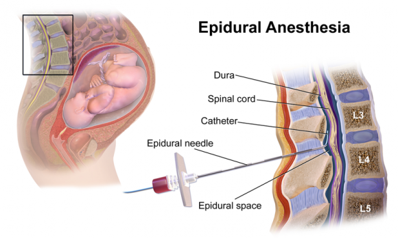 Epidural_Anesthesia WIKI